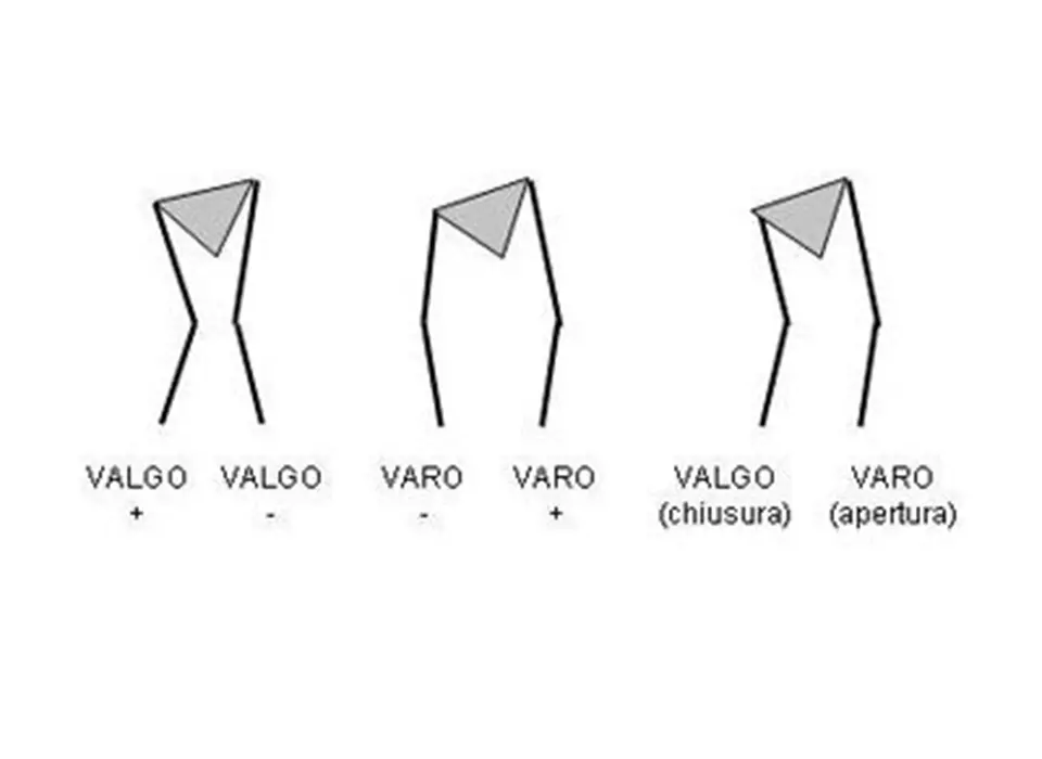 Disegno per spiegare le differenze tra valgo varo e valgo chiusura e apertura per l'articolo sulla dismetria