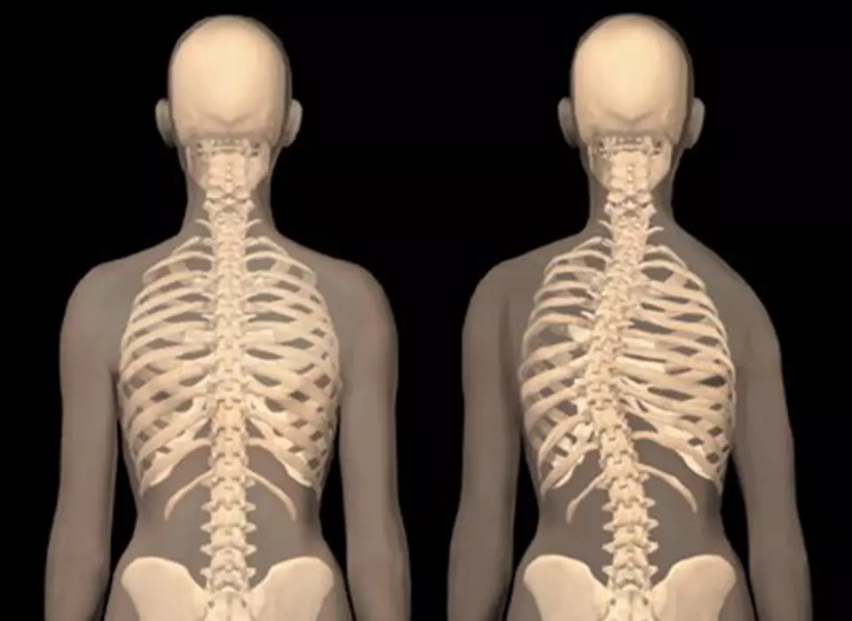 Disegni di due scheletri per dimostarre le differnze a livello di spina dorsale tra chi ha una dismetria e chi non ce l'ha